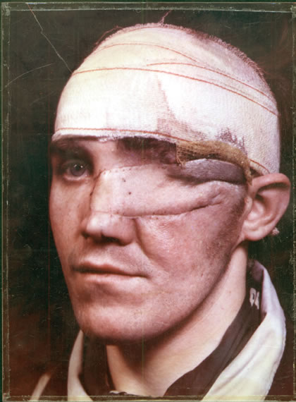 Photograph of reconstructive surgery by Percy Hennell